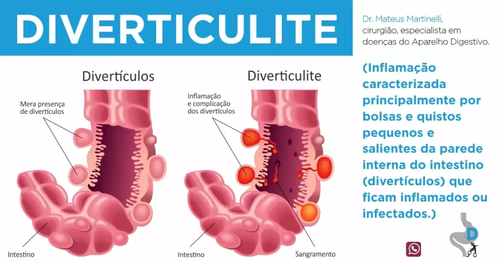 sintomas clínicos da diverticulite