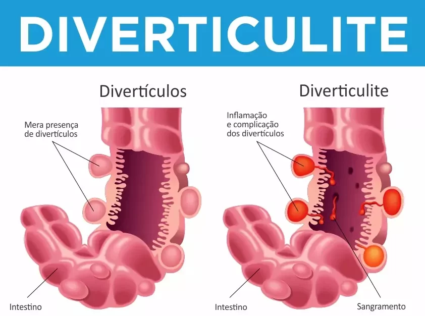 sintomas clínicos da diverticulite